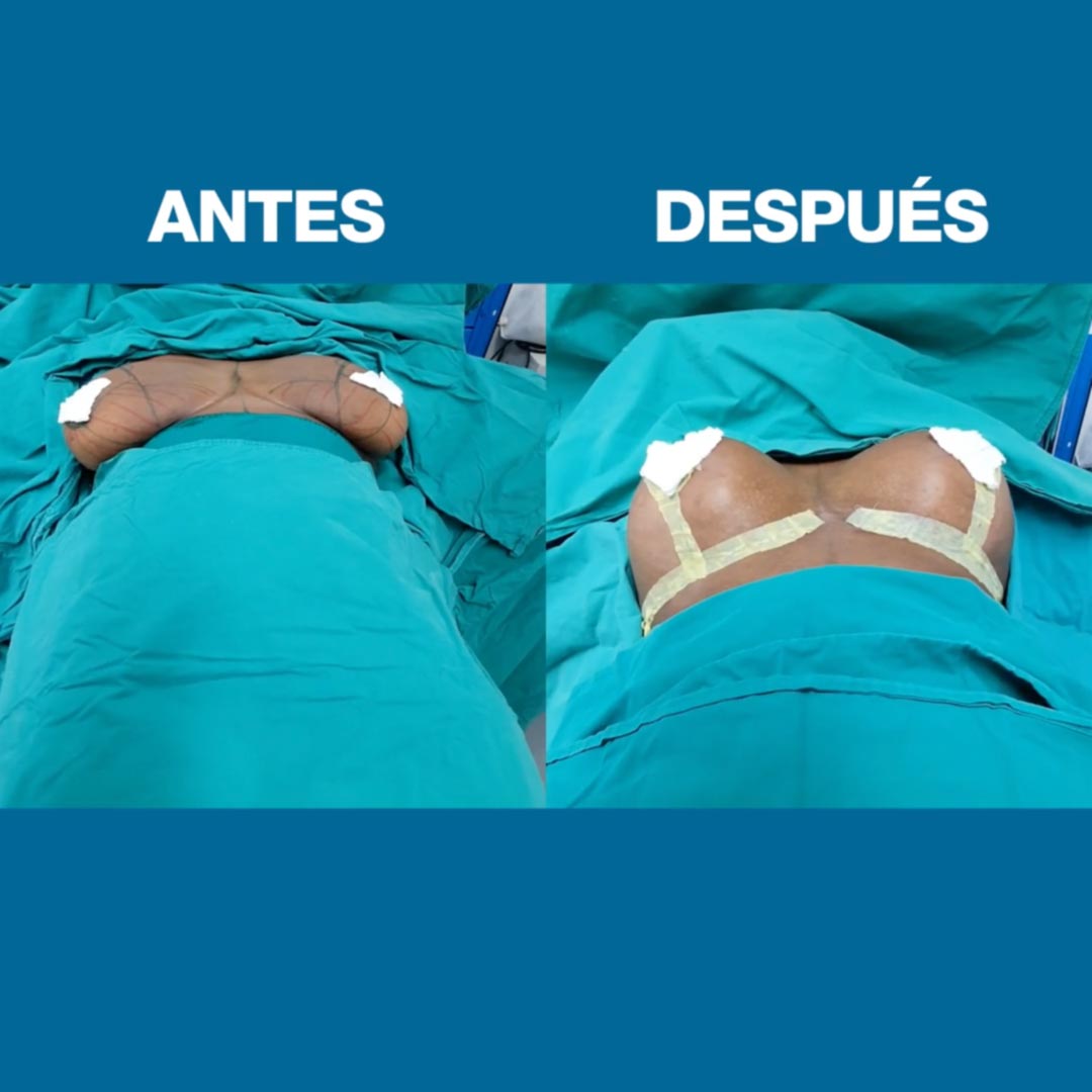Lipoescultura
